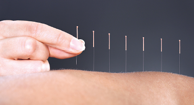 Photo: Image of acupuncture needles on the skin
