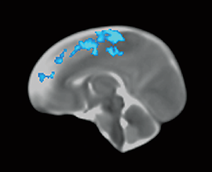 Photo of a neonate brain image that shows some gray matter decreases.