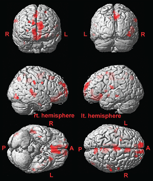 Photos of six brain images taken from subjects with schizotypal personality disorder are shown.