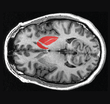 Photo: Brain scan
