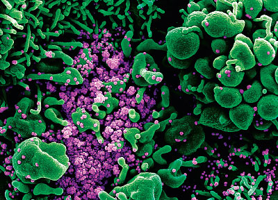 Photo: Colorized scanning electron micrograph of a cell (green) heavily infected with SARS-COV-2 virus particles (purple) from a patient sample.