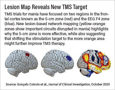 Photo: Lesion Map Reveals New TMS Target