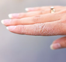 Photo: hand with eczema