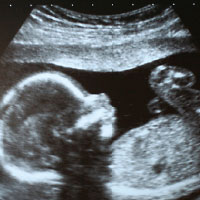 Graphic: Fetus Ultrasound