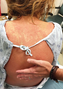 Figure 1: The photo shows a characteristic rash of a patient with DRESS (drug reaction with eosinophilia and systemic symptoms).