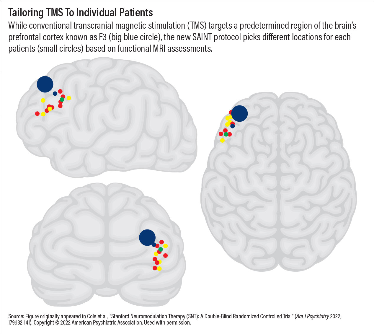 Photo: Tayloring TMS to Individual Patients
